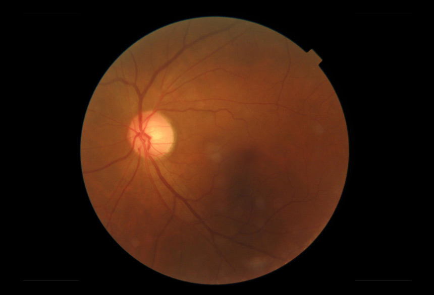 닥터눈 Fundus